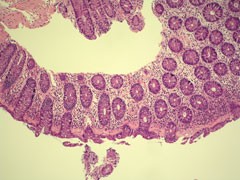 Kollagene Kolitis HE