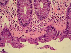 Kollagene Kolitis HE_vergroeßert