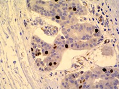 Östrogen-Rezeptor_positiv