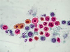 Kleinzelliges_arcinoma